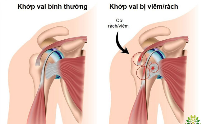 Liệu bạn đã biết viêm quanh khớp vai chữa thế nào tốt