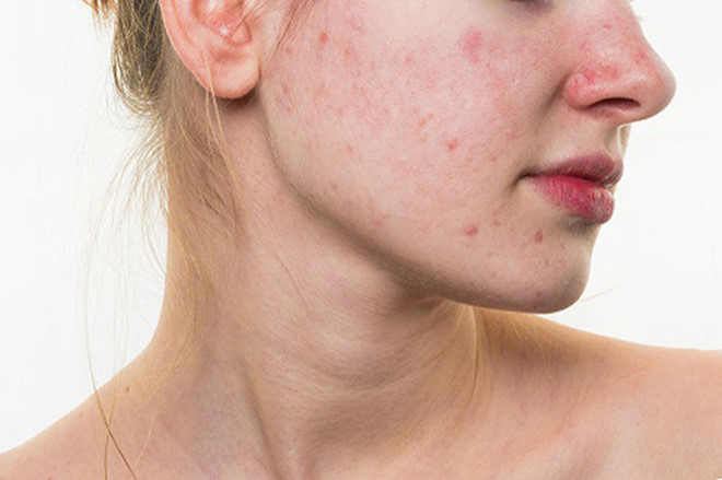 Hormone bị thay đổi cũng khiến cho chị em nổi mụn