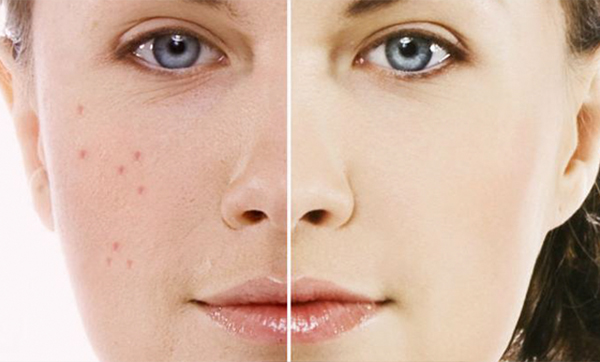 Thiếu ngủ và stress là hai hội chứng gián tiếp gây ra mụn